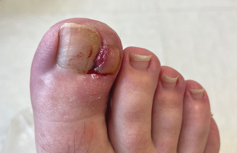 Photo avant intervention de Mme L. On y observe une onychochryptose sur le bord latéral de l'hallux avec botriomycome associé