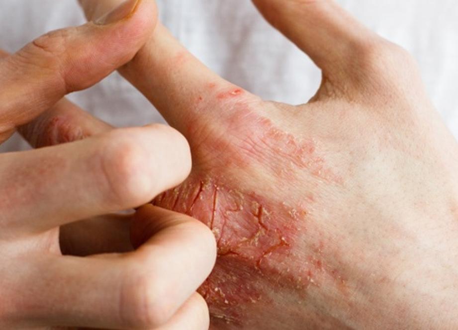 Dermatite Atopique : une nouvelle campagne "qui dit tout haut ce que la peau crie tout bas"