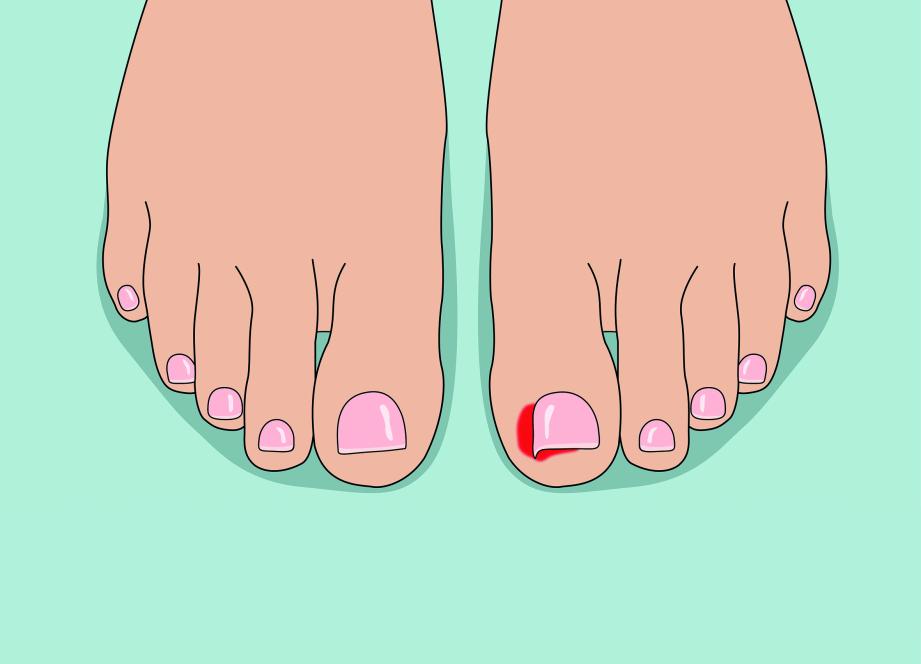 Du local au national, le long chemin de la phénolisation de l’ongle incarné