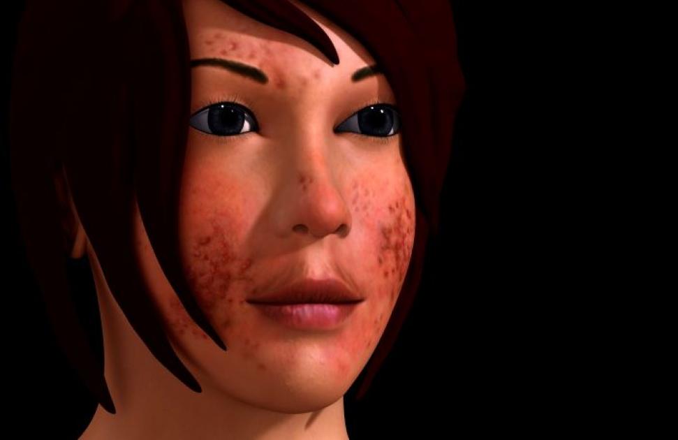 acné chez une adolescente