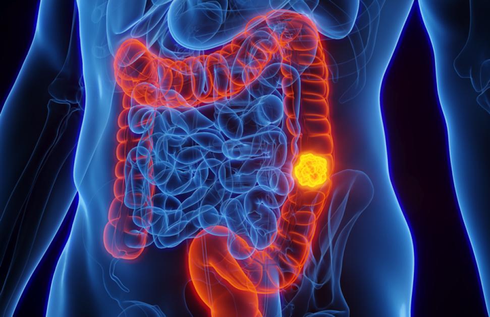 Cancer colorectal : bilan du dépistage organisé dans un SPST
