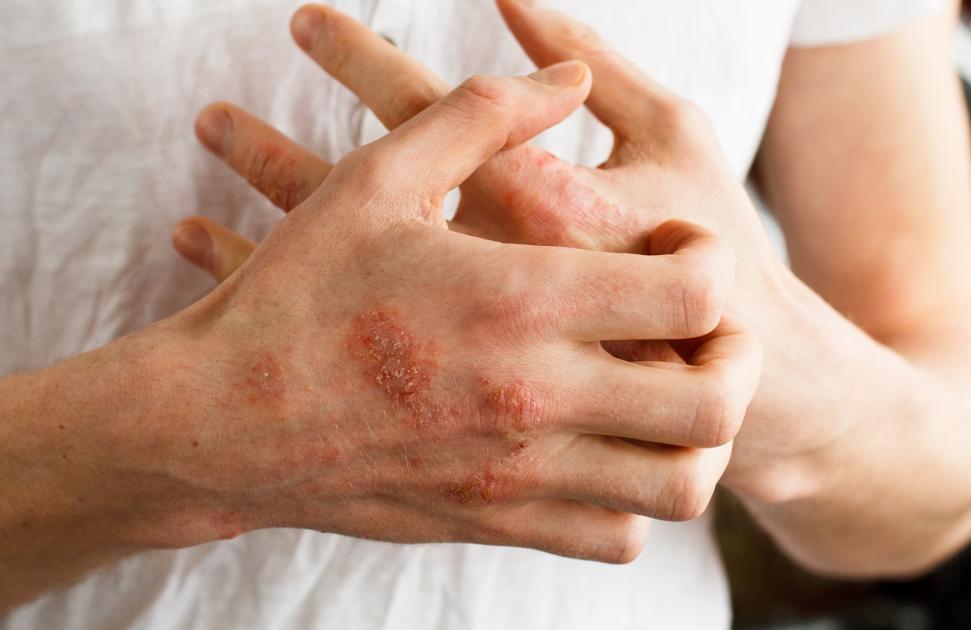 Dermatite atopique : plus de 4 patients sur 10 manquent de soutien psychologique pour gérer les répercussions mentales de la maladie