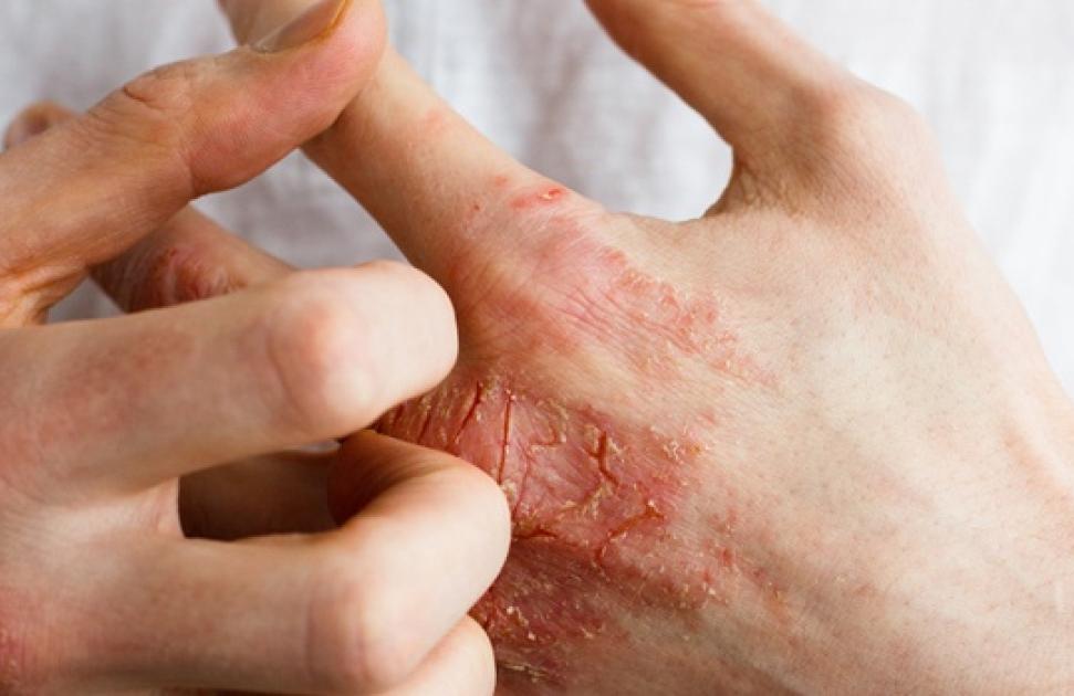 Dermatite Atopique : une nouvelle campagne "qui dit tout haut ce que la peau crie tout bas"