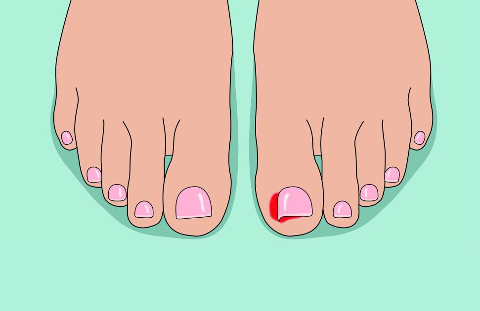 Du local au national, le long chemin de la phénolisation de l’ongle incarné
