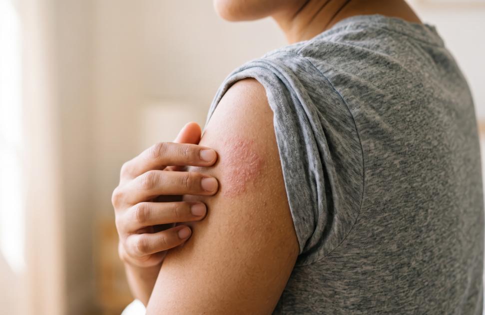 "Soigner la peau ne suffit pas" : un Livre noir révèle "la face cachée" de l'eczéma