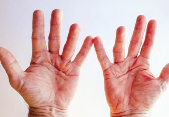 Maladie de Dupuytren