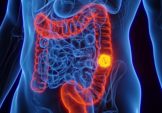 Cancer colorectal : bilan du dépistage organisé dans un SPST