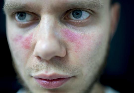 Lupus systémique : le lien avec le monde du travail