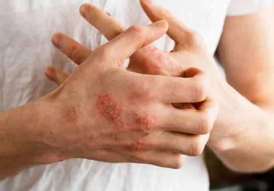 Dermatite atopique : plus de 4 patients sur 10 manquent de soutien psychologique pour gérer les répercussions mentales de la maladie