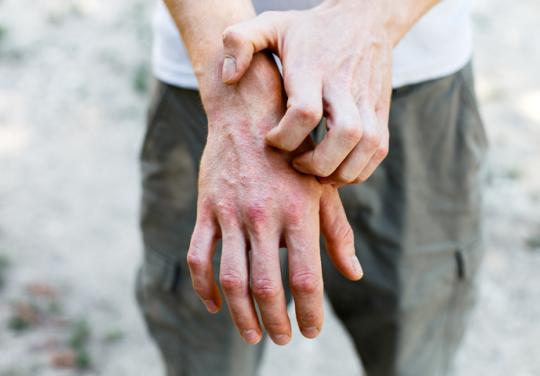 Association française de l'eczéma : lutter ensemble pour des patients à fleur de peau