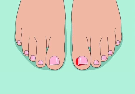 Du local au national, le long chemin de la phénolisation de l’ongle incarné