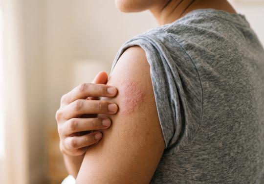 "Soigner la peau ne suffit pas" : un Livre noir révèle "la face cachée" de l'eczéma